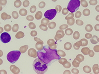 Mixed phenotype acute leukemia with t(9;22)(q34;q211.2); BCR-ABL