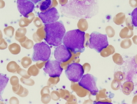 Acute-undifferentiated-leukemia-Bone-Marrow-high-power