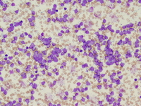 Acute-undifferentiated-leukemia