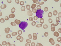 Acute undifferentiated leukemia