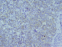 Myeloid-sarcoma