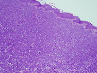 Extramedullary Myeloid Tumor