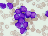 Acute-myeloid-leukemia-with-mutated-NPM1