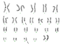 Acute-myeloid-leukemia-with-the-t821q2222