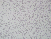 Aplastic Anemia and Paroxysmal Nocturnal Hemoglobinuria (PNH) clone