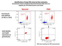 Aplastic-Anemia-and-Paroxysmal-Nocturnal-Hemoglobinuria-Flowcytometry