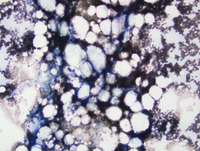 Aplastic-Anemia-and-Paroxysmal-Nocturnal-HemoglobinuriaBone-marrow-Aspirate