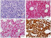 ALL-Ph-CD-13-positive-special-stains