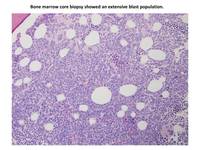 ALL-Ph-CD-13-positive-biopsy