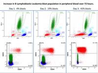 B-cell-ALL-serial-flow-during-rapid-WBC-rise