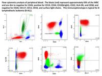 B-cell-ALL-flow-cytometry