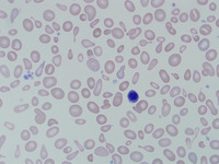 Congenital-sideroblastic-anemia-peripheral-blood