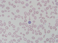 Congenital-sideroblastic-anemia-peripheral-blood