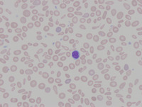 Congenital Sideroblastic Anemia