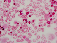 Congenital-sideroblastic-anemia-iron-stain