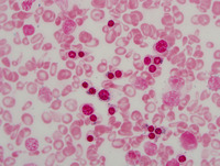 Congenital-sideroblastic-anemia-iron-stain