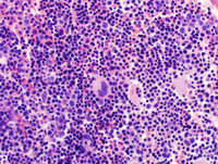 Congenital-sideroblastic-anemia-biopsy