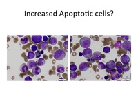 Diamond-Blackfan-Anemia-Aspirate