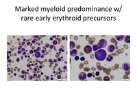 Diamond Blackfan Anemia Aspirate