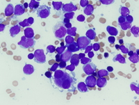 AML-with-inv3q21q262-Aspirate-low-power-view