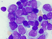 AML with inv(3)(q21q26.2)