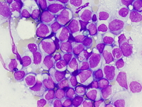 Therapyrelated-myeloid-neoplasm-Acute-myeloid-leukemia