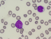 Therapy-related myeloid neoplasm (acute myeloid leukemia)