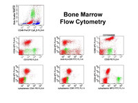 Acute-Megakaryoblastic-Leukemia-Flow-Cytometry