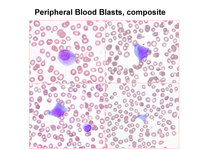 Acute-Megakaryoblastic-Leukemia
