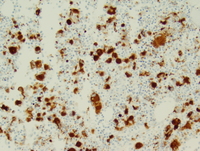 Myeloid leukemia associated with Down syndrome 6