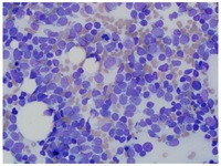 T-cell-ALL-Biopsy