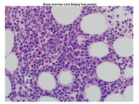 T-cell-ALL-Marrow-Biopsy