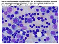 Paroxysmal-nocturnal-hemoglobinuria--PNH-Aspirate