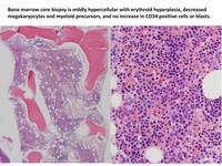 Paroxysmal-nocturnal-hemoglobinuria-PNHBiopsy
