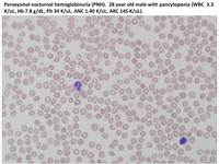Paroxysmal nocturnal hemoglobinuria (PNH)