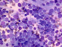 Neuroblastoma-bone-marrow
