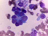 Neuroblastoma-bone-marrow