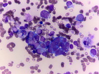 Neuroblastoma-bone-marrow