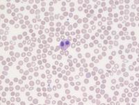 Hematolymphoid neoplasm with PDGFRA rearrangement 8