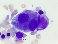 Refractory cytopenias with unilineage dysplasia 1