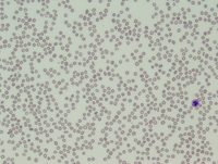 Refractory cytopenias with unilineage dysplasia 4