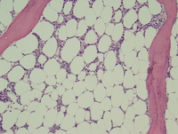 Refractory cytopenias with unilineage dysplasia 5