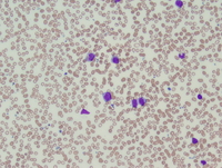 Acute-myeloid-leukemia-with-myelodysplasiarelated-changes-1