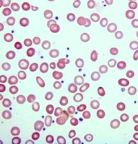 Iron-Deficiency-Anemia-Moderate