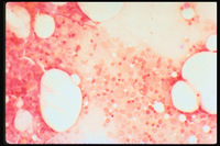 Iron-Deficiency-Anemia