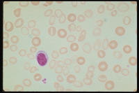 Iron-Deficiency-Anemia-Severe