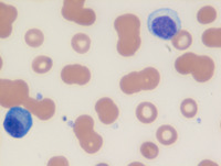Rouleax formation in myeloma