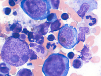 Parvovirus in marrow pronormoblasts