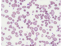 Hereditary pyropoikilocytosis