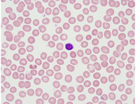 Normocytic rbcs with lymphocyte for comparison